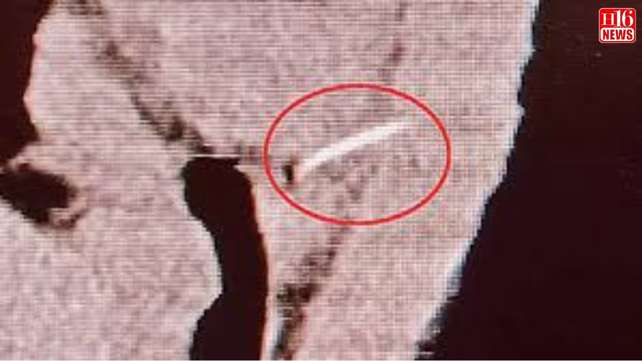 Andhra Pradesh | Doctor's Performs Surgery to Remove Fish Bone Canal Heart