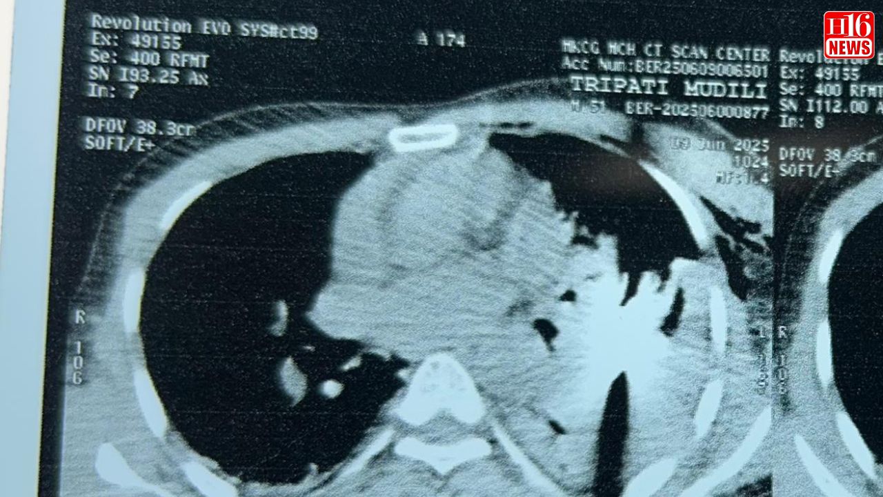 Doctors' Row Arrow Lodged Close to Man's Heart in Odisha
